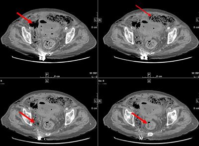 The mystery of abdominal snow-grip sensation: emphysematous cystitis complicated with bladder gangrene and rupture—case report and literature review